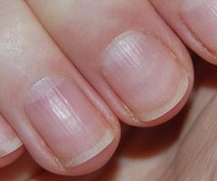 Nail lines and treatment